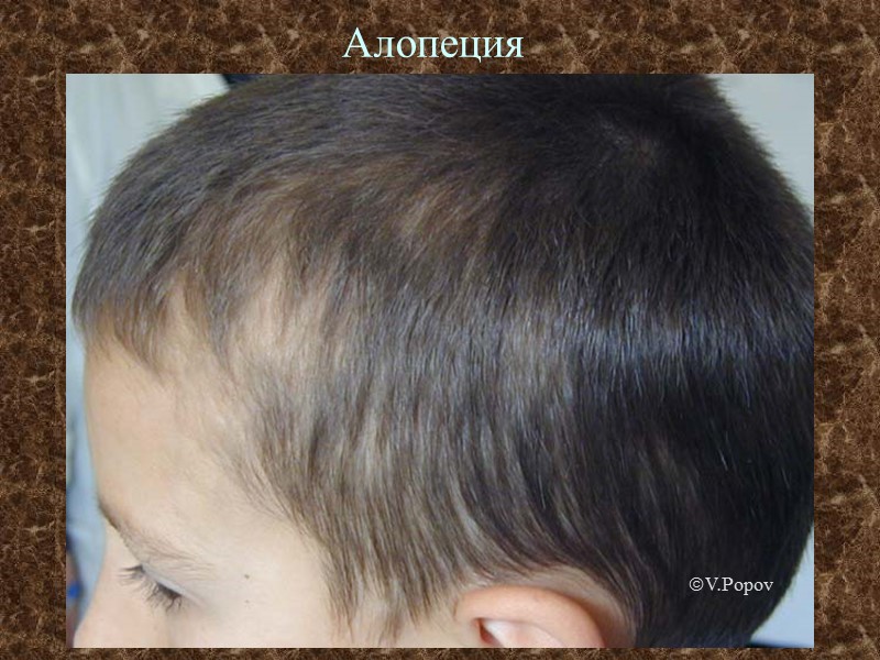 Алопеция г V.Popov